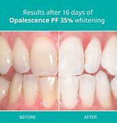 Image result for Opalescence Teeth Whitening
