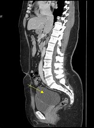 Image result for Adnexal Cyst CT