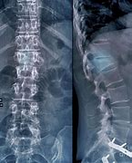 Image result for Burst Fracture Lumbar Spine