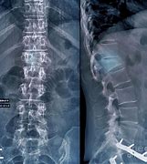 Image result for Lumbar 1 Fracture