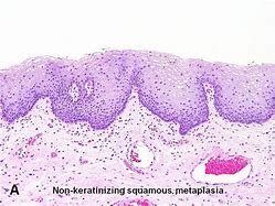Image result for Squamous Metaplasia Bladder