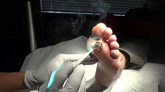 Image result for Wart Removal System
