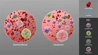 Image result for What Is Leukemia Cancer