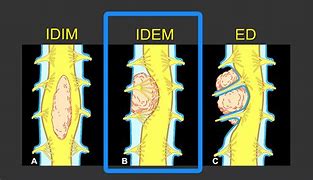 Image result for Meningioma Cervical Spine Tumor