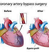 Image result for Triple Bypass Heart Surgery