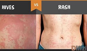 Image result for Skin Rash Hives Treatment