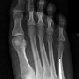Image result for Treating a Jones Fracture