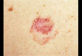 Image result for Non-Melanoma Skin Cancer