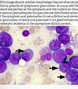 Image result for Acute Myeloid Leukemia Disease