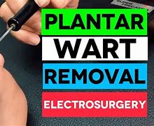 Image result for Wart Removal Process