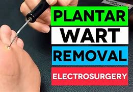 Image result for Plantar Wart Cut Out