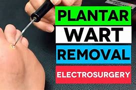 Image result for Plantar Wart Root Removal