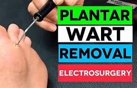 Image result for Plantar Wart Removal Surgery
