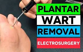 Image result for Wart On Thigh Removal