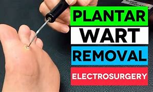 Image result for Plantar Wart On Finger Removal