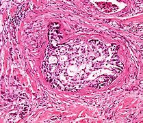 Image result for Adenocarcinoma Lung Cancer