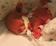 Image result for Premature Babies 24 Weeks