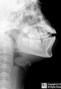 Image result for Thumbprint Sign Epiglottitis