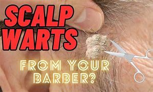 Image result for Wart Remover for Scalp