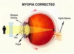 Image result for Myopia