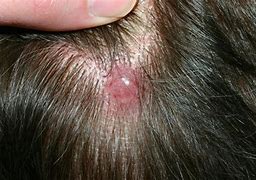 Image result for Basal Cell On Scalp