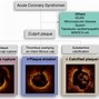 Image result for Acute Coronary Syndrome Plaque Rupture