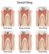 Image result for Dental Filling Procedure