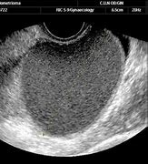 Image result for Residual Ovarian Cyst Ultrasound