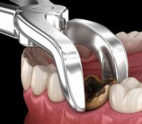Image result for Tooth Extraction Bone Showing