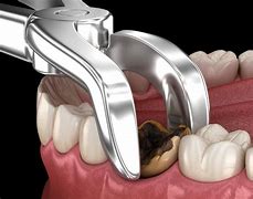 Image result for Images of Tooth Extraction