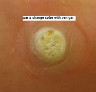 Image result for Female Genital Warts Mild Case