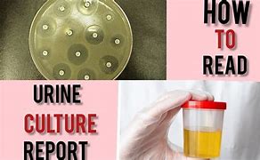 Image result for 20-Day Urine Culture
