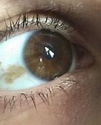 Image result for Brown Spot On Eye White