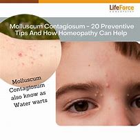 Image result for Molluscum Contagiosum Soap