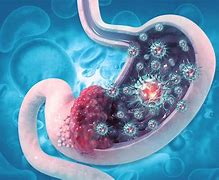Image result for Bloated Stomach Cancer