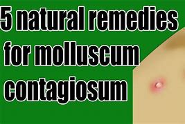 Image result for Infected Molluscum