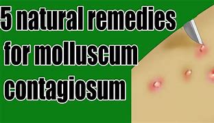 Image result for Molluscum Contagiosum Pictures and Symptoms