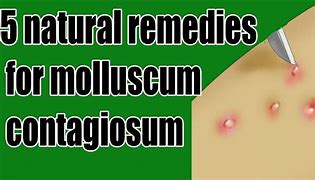 Image result for Molluscum Contagiosum India