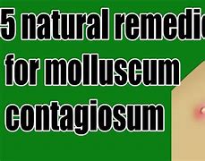 Image result for Getting Rid of Molluscum Contagiosum