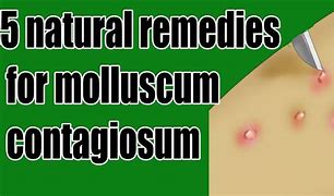 Image result for How to Cure Molluscum Contagiosum