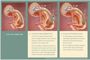 Image result for Fetal Spina Bifida