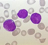 Image result for Acute Leukemia Blood Smear