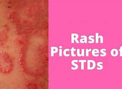 Image result for Sexually Transmitted Skin Diseases