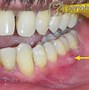 Image result for Gum Fistula From Tooth Abscess