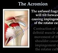 Image result for acromoal
