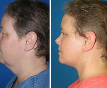 Image result for Sharp Chin Syrgery