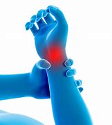Image result for Arthritis in Wrist