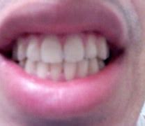 Image result for Messed Up Bottom Teeth