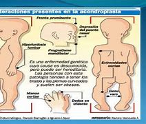 Image result for acondroplasis