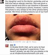 Image result for Allergic Reaction around Lips